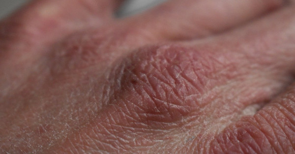 Skin Is Handy, So Protect It